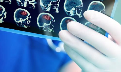 Brain Scans Reveal a Possible Biomarker for Suicidal Thoughts in PTSD