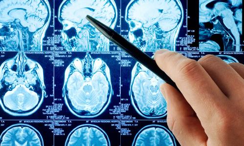 Unique Neural Activation Pattern in People With Co-Occurring Bipolar Disorder and Alcohol Use Disorder Points to Future Treatment Targets