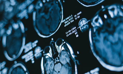 brain scans