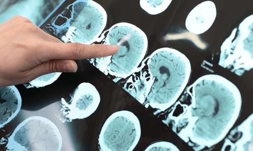 Testing a New Way to Precisely Target and Predict the Impact of TMS Brain Stimulation for Depression