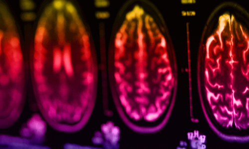 Imaging Study Links Changes in Function and Structure of the Hippocampus in Early Psychosis